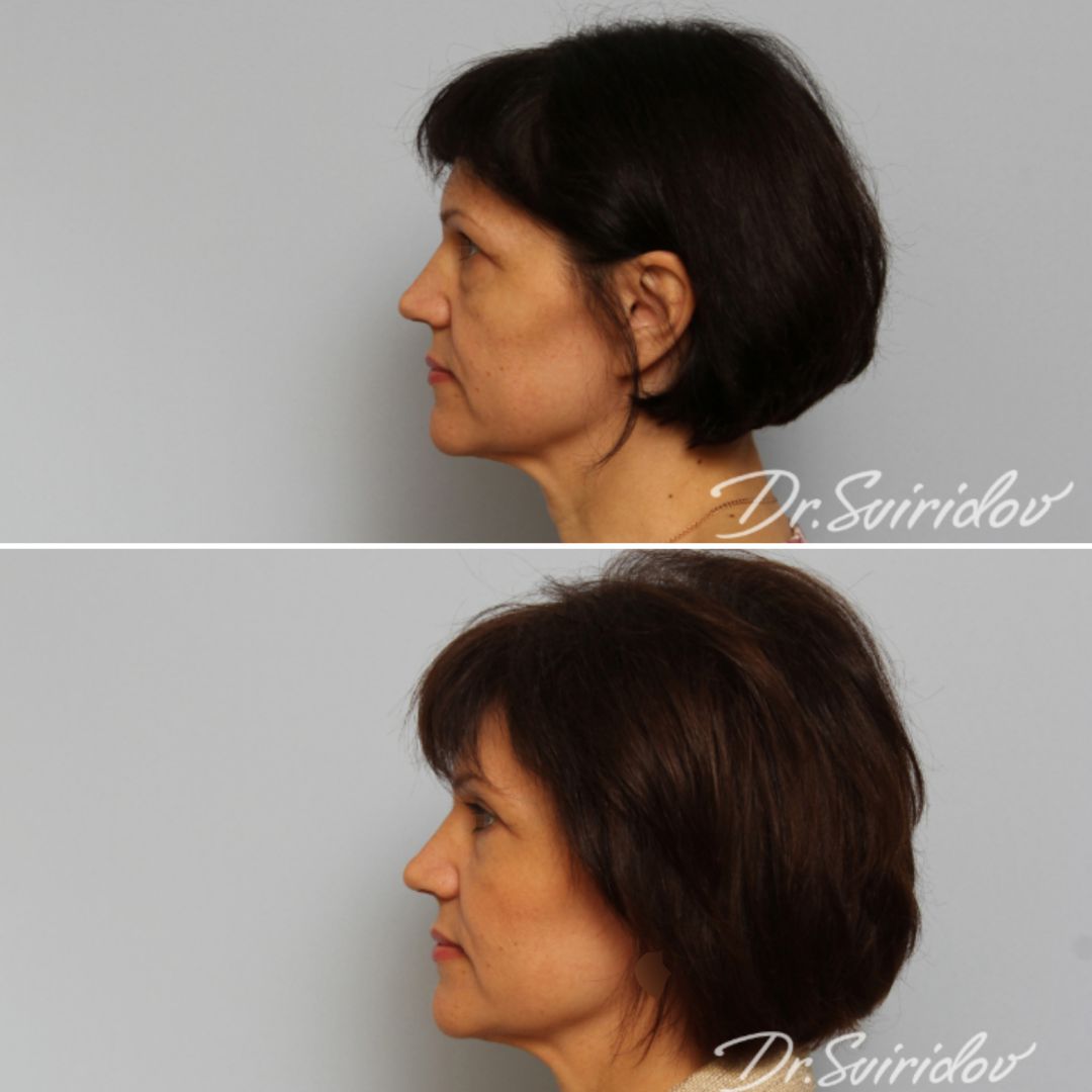 Как избавиться от «мешков» под глазами?