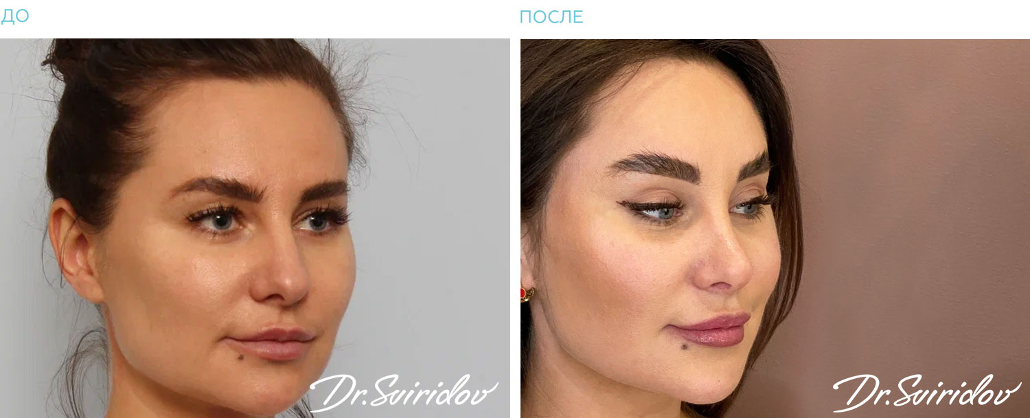 До/После