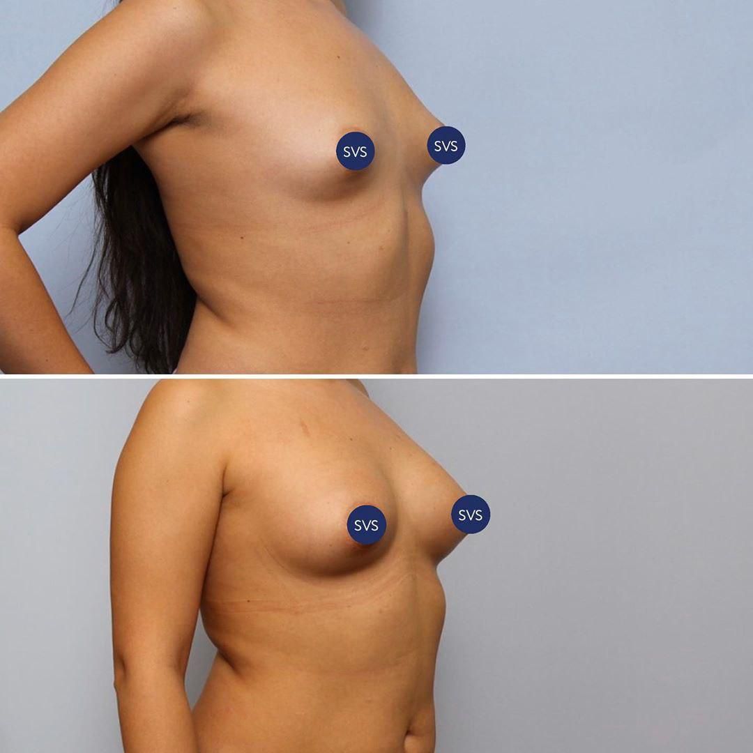 грудь тубулярная у женщин фото 32