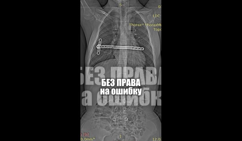 Пациентке в детстве была установлена специальная пластина для выпрямления грудной клетки.