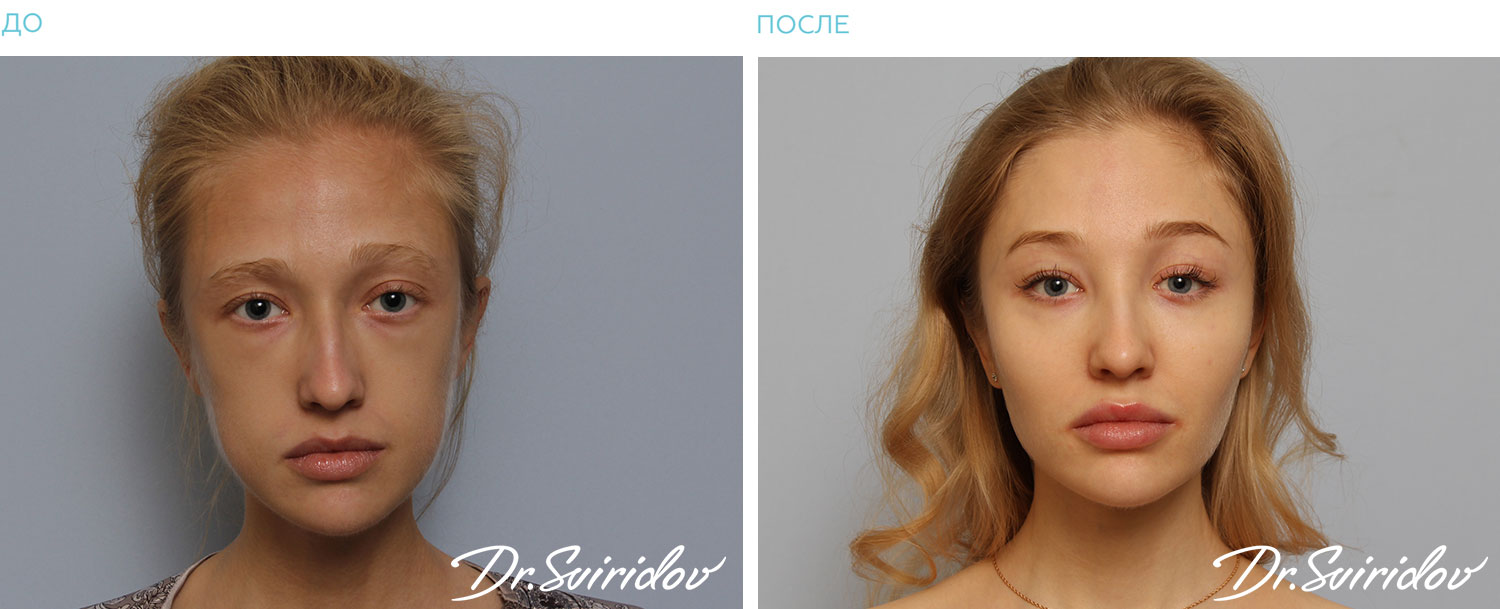 До/После До/После